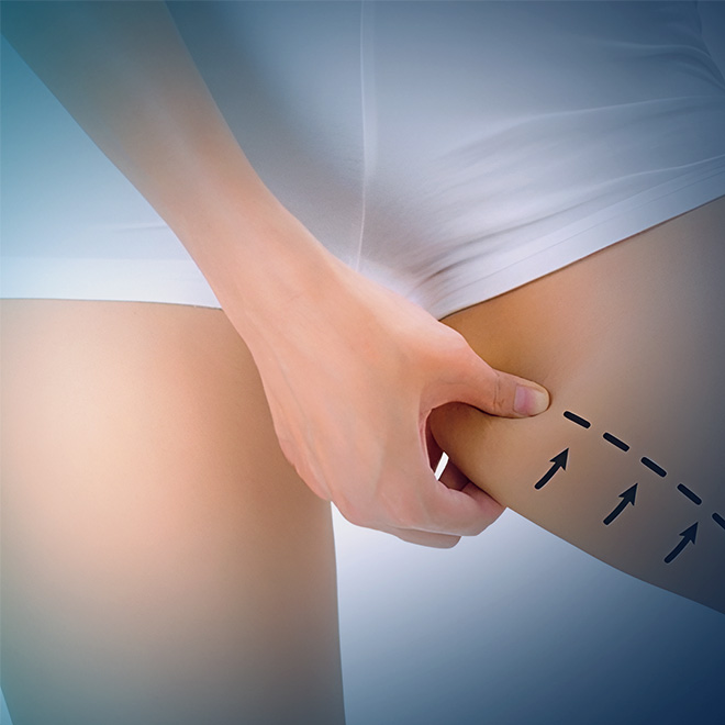 Thigh Lift