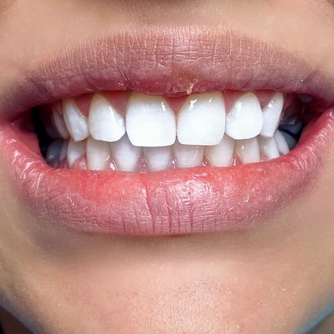 zirconium-veneers-9