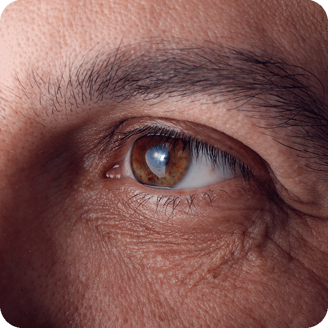 cataract-eye-surgery-14