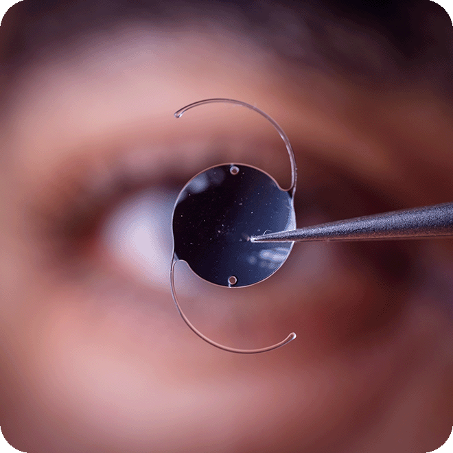 cataract-eye-surgery-4