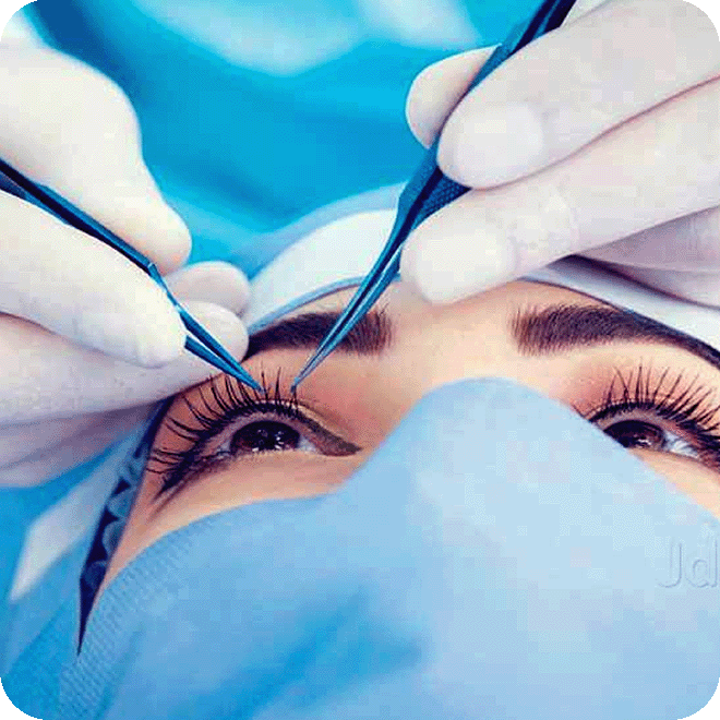cataract-eye-surgery-5
