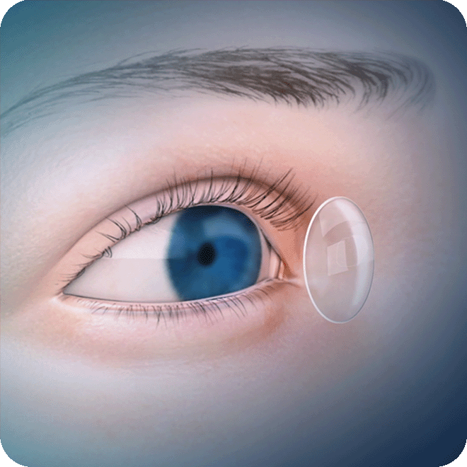 corneal-transplant-2