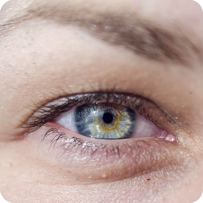 corneal-transplant-5