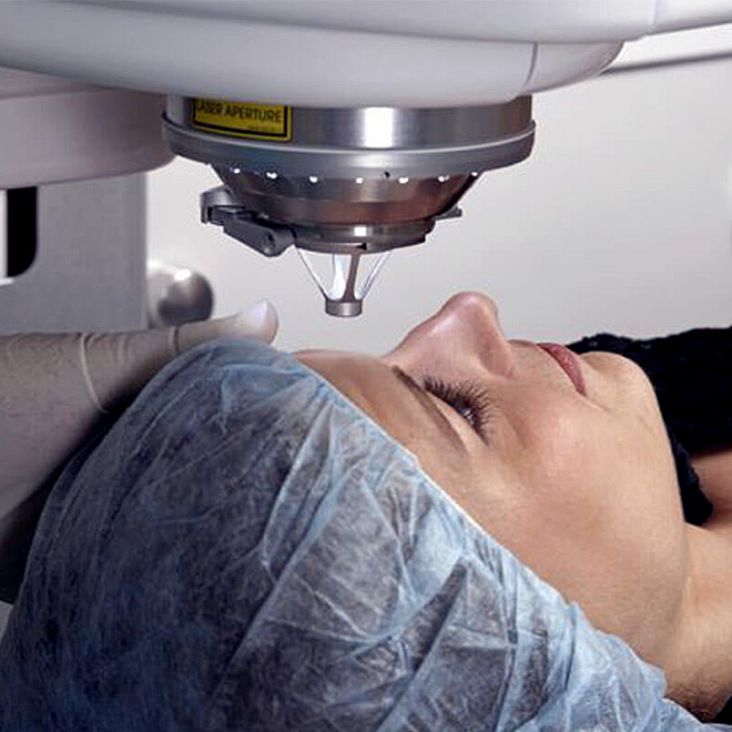 smile-lasik-5
