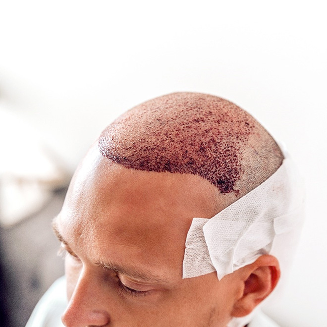 hair-transplant-4