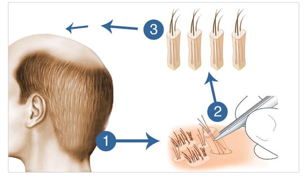 Hair-Transplant-Technology-